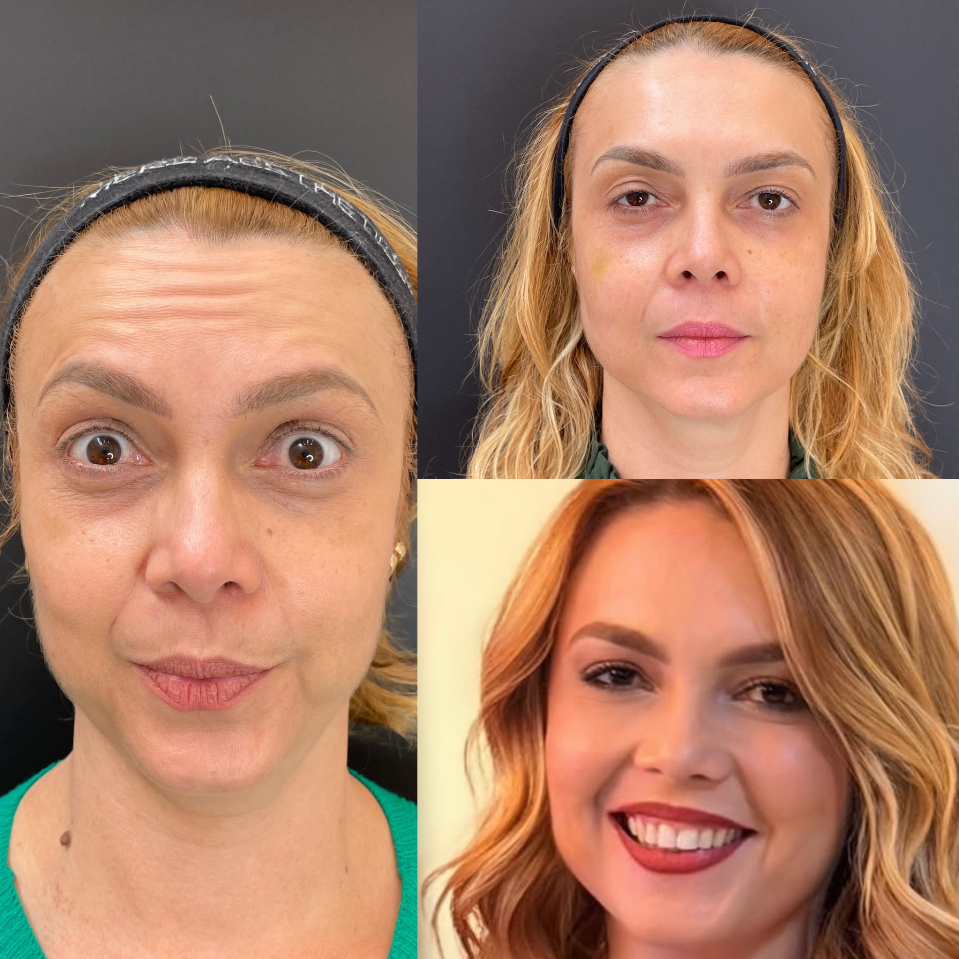 Transformação facial · antes e depois